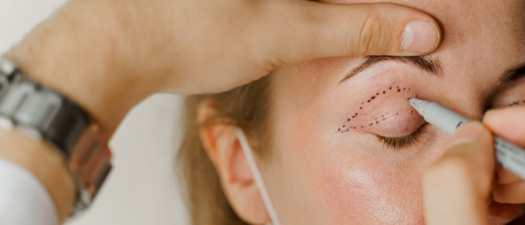 Praxis für Kiefer-Gesichts-Chirurgie und Ästhetik Dr. Meurer Vechta – Schlupflider und Tränensäcke durch Lidplastiken beseitigen