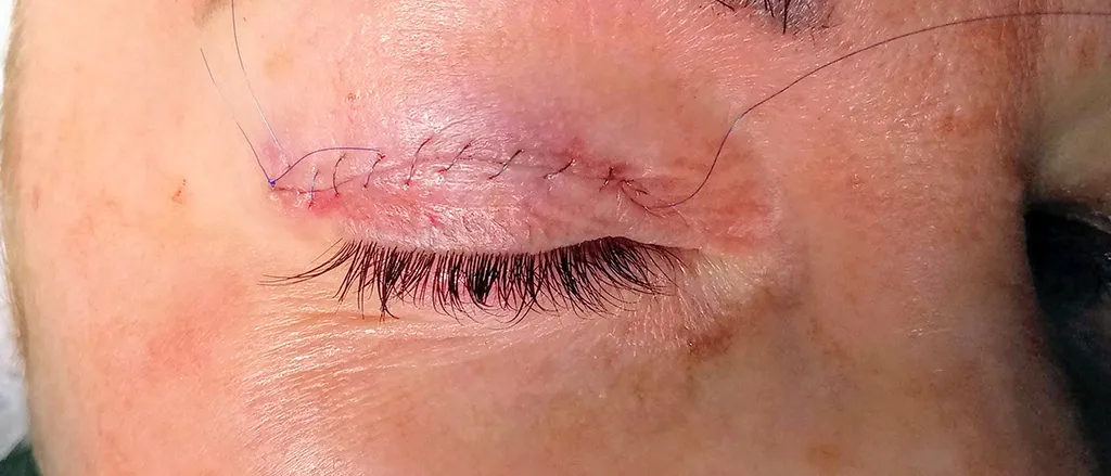 Praxis für Kiefer-Gesichts-Chirurgie und Ästhetik Dr. Meurer Vechta – Blepharo